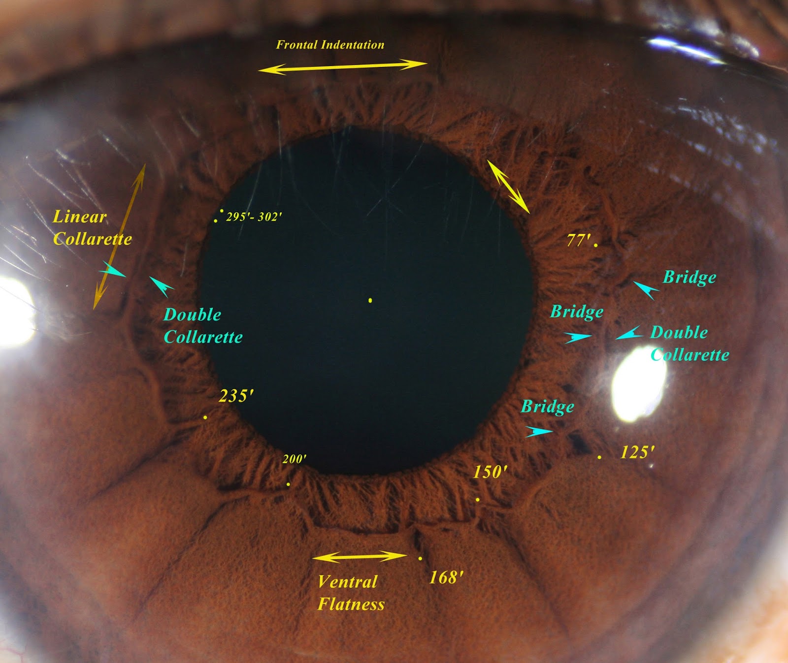 Modern & Multidimensional Iridology The Collarette Structure & Signs