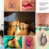 Mengobati Wasir (Ambeien) Tanpa Bedah Stapler thumbnail