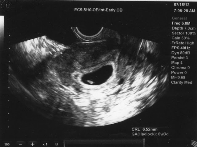 On see should 6 a week ultrasound you what 6 Week