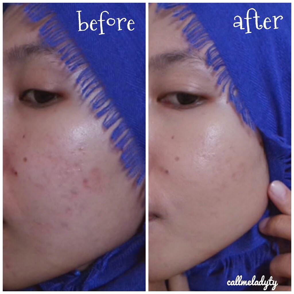 Tuty Saca Elf Acne Fighting Foundation in shade Buff