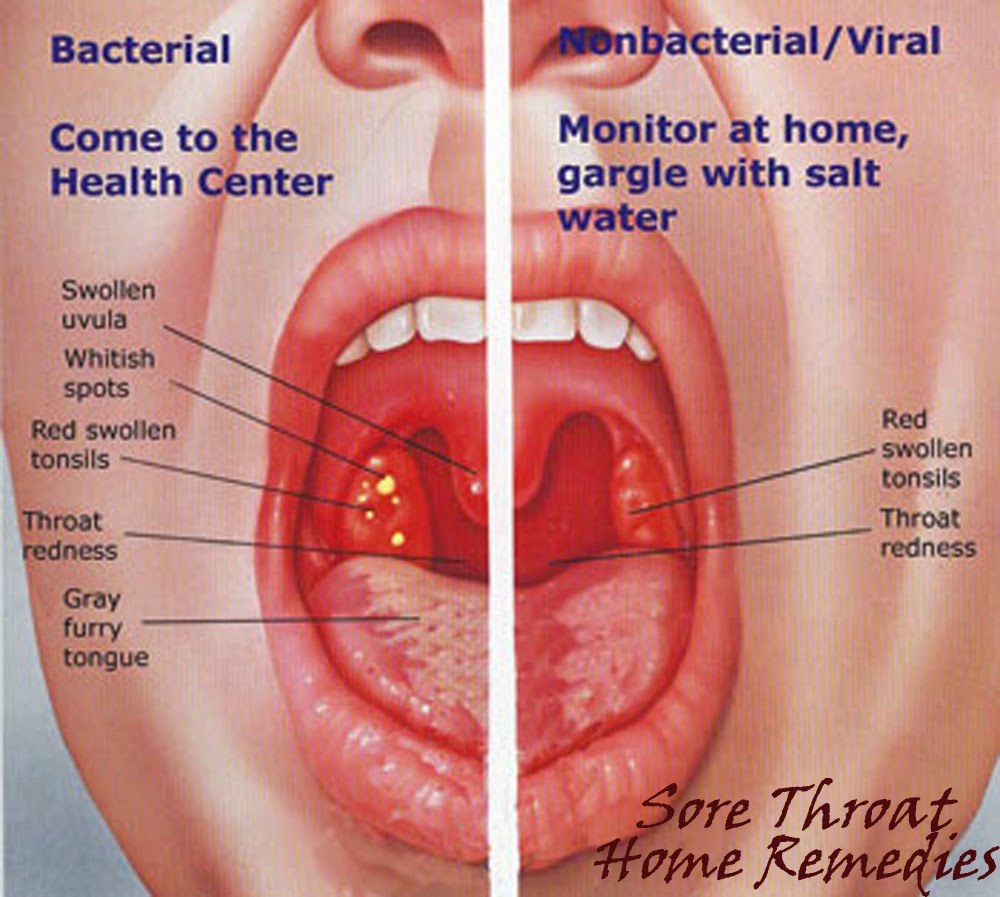 Pharyngitis. Treatment with folk remedies Pharyngitis. Treatment with folk remedies