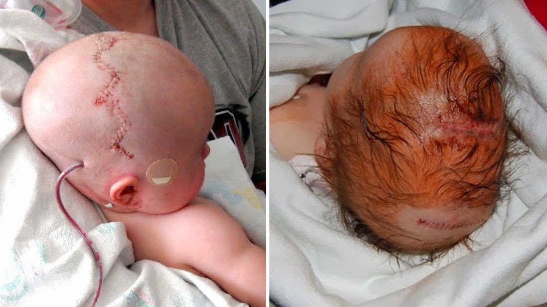 Our Journey with Sagittal Craniosynostosis