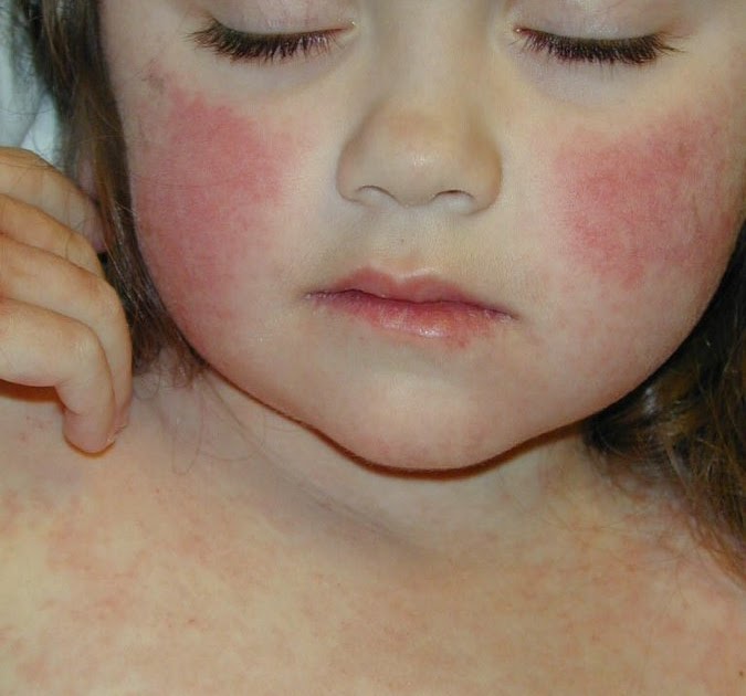 Blog2Best โหลดแอพ android ฟรี Fifths disease