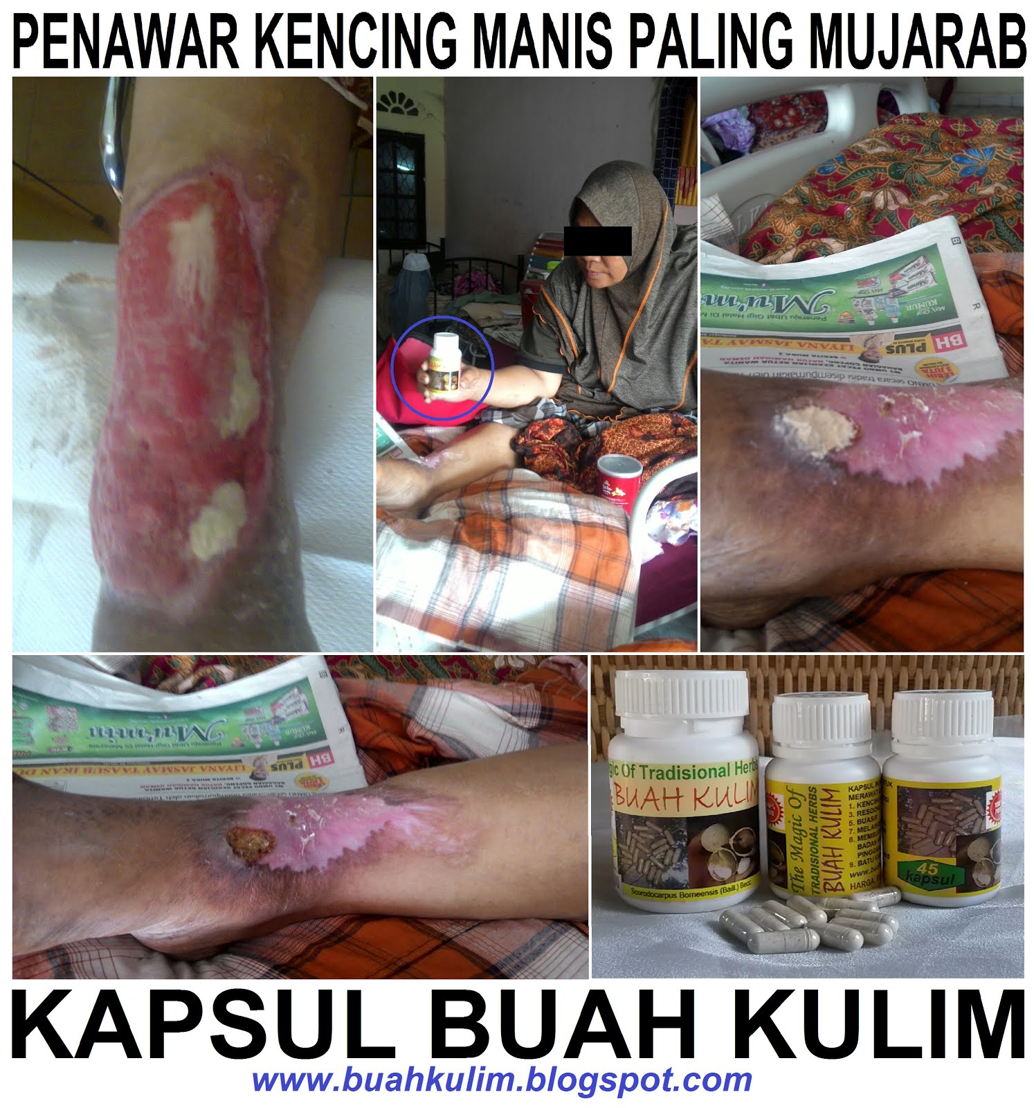 Luka Kencing Manis Pulih Dengan Pantas