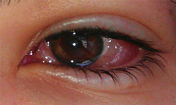 Goz Kanlanmasi Tehlikeli Mi Goz Kanlanmasi Nedenleri Ve Tedavi Yontemleri