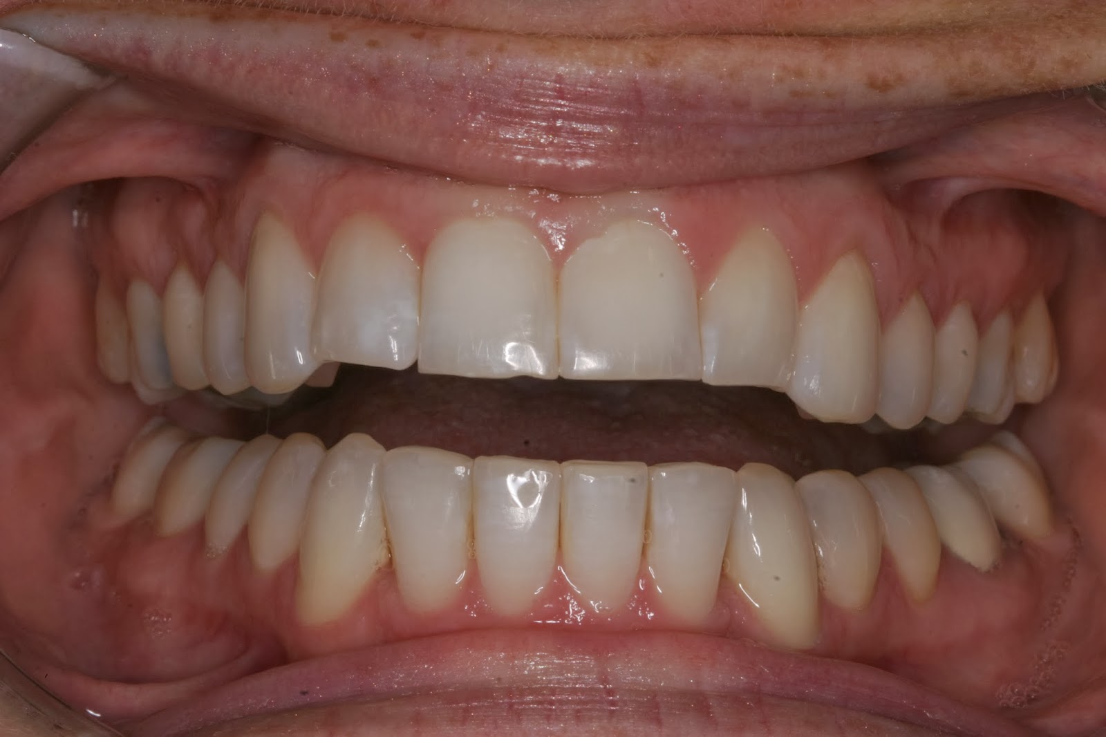 TCDO Blog Veneers, Veneers and More Veneers