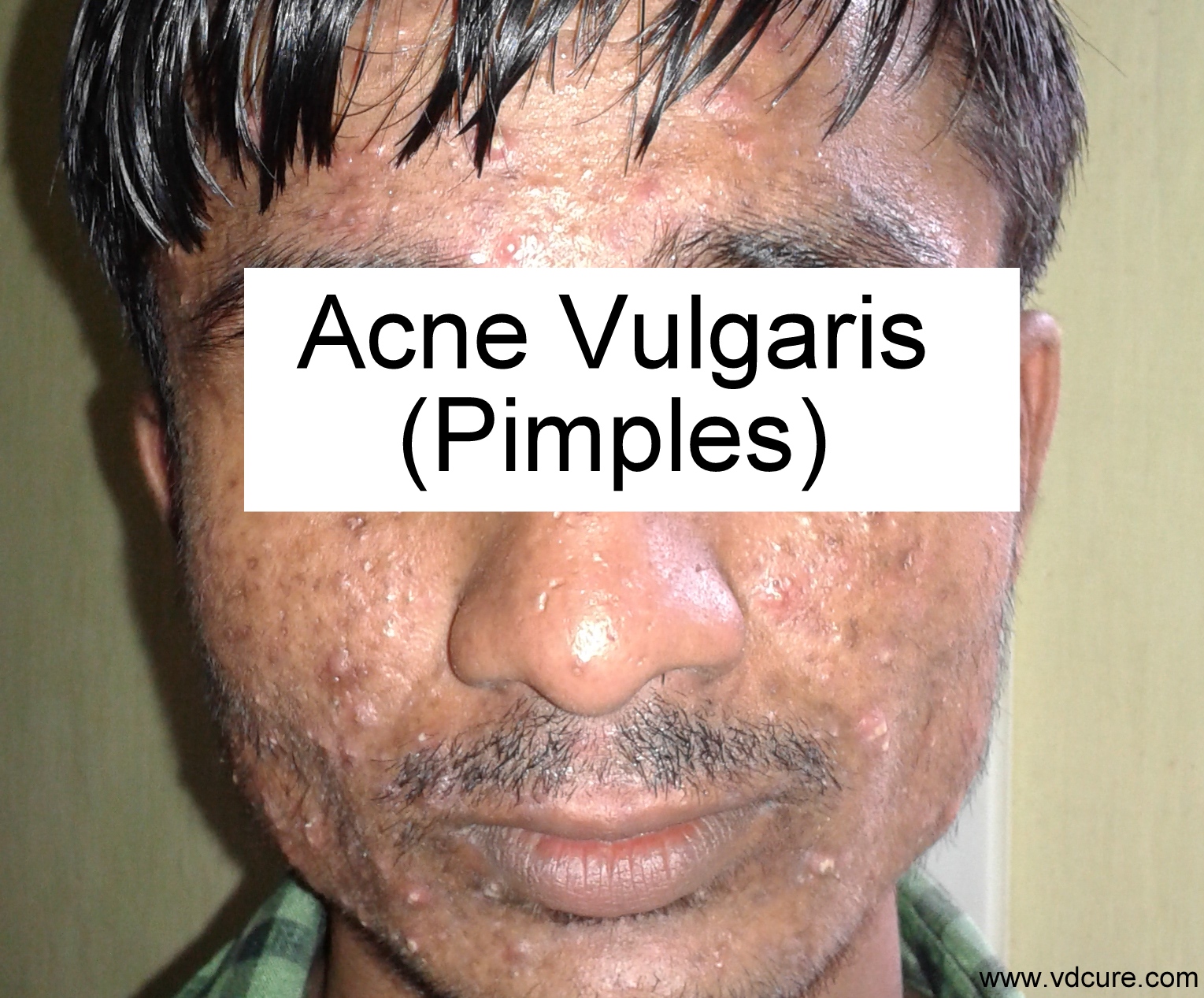 Best medicines for Pimples or Acne avilable in the market.