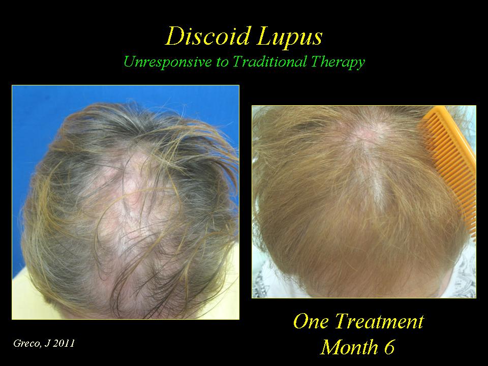PRP Treatment brings Back Hair in Discoid Lupus Patient Greco Hair