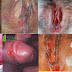 Penyembuhan Luka Pada Kelamin Penis