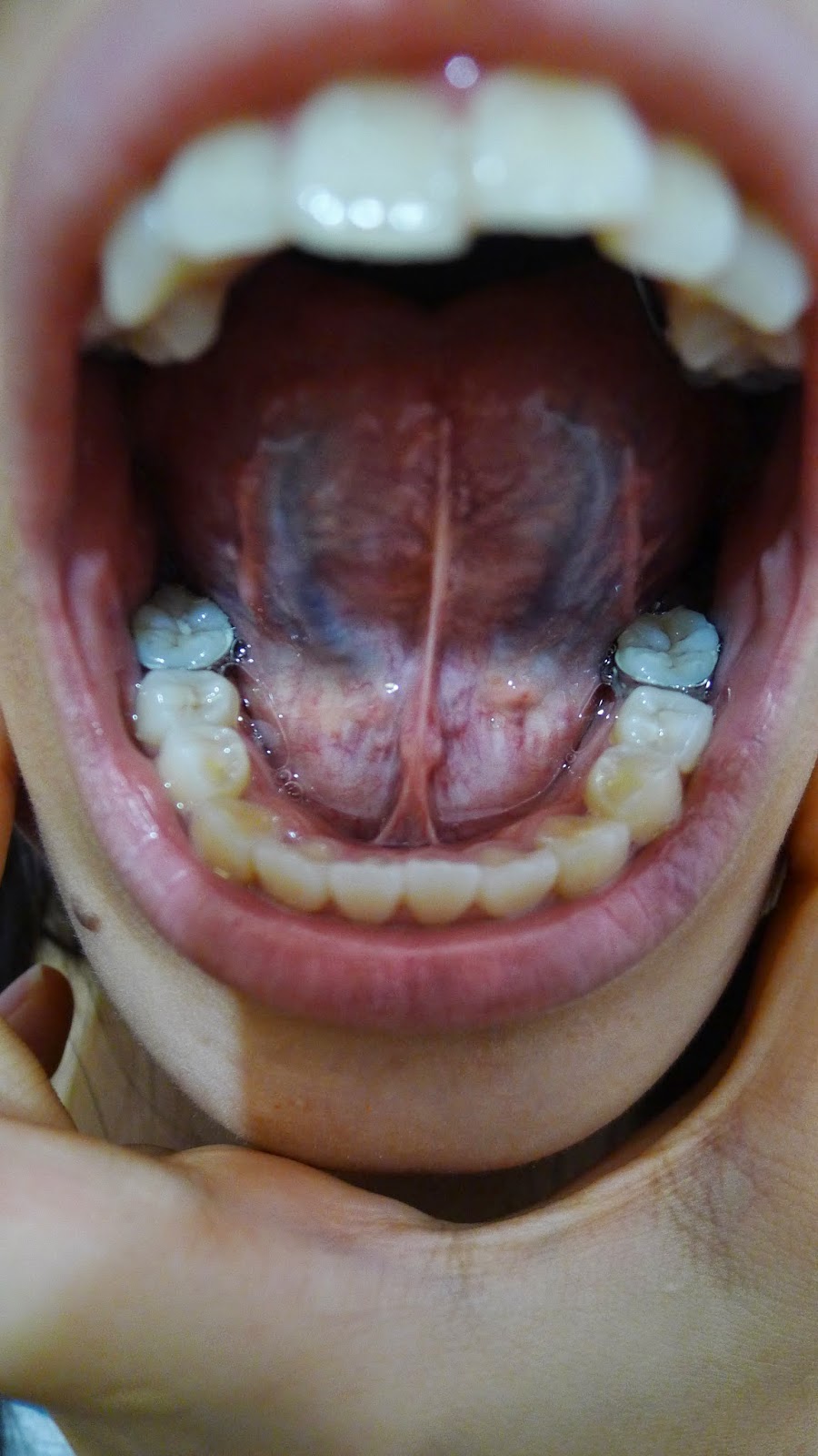 Of lifestyle, braces and good food Journey of a metalmouth girl