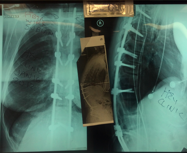 Kyphosis surgery today for Proximal Junctional Kyphosis (PJK) with new fiber wire technique to