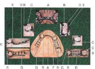 Components of a removable partial denture image62 Components of a removable partial denture