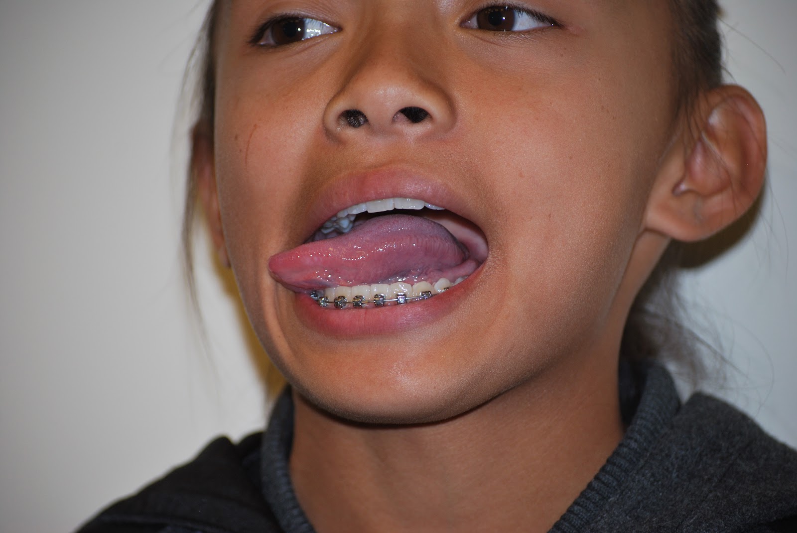 Tongue exercises Somnolescences