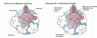 asma bronquial