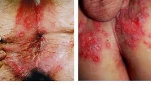 Penyakit Herpes Pada Kelamin Penyakit Herpes Pada Kelamin