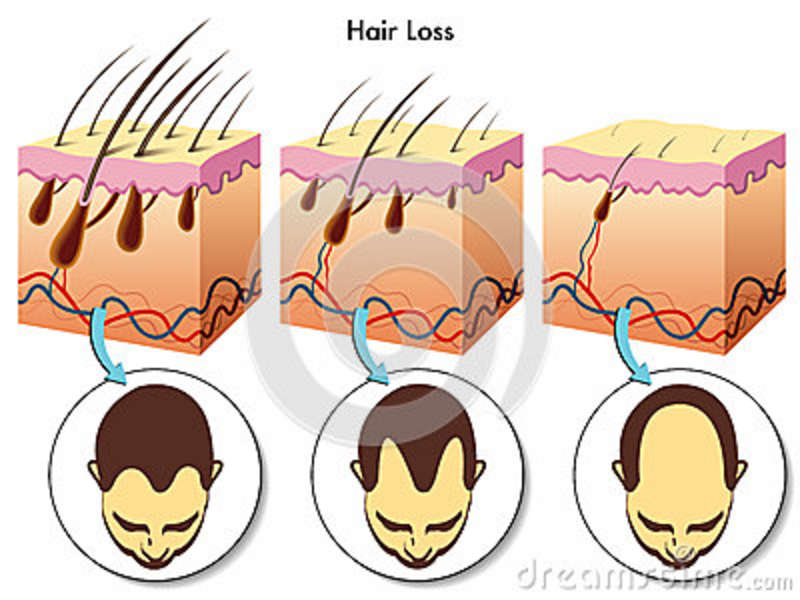 Adrenal Tumor Hair Loss : The Myths And The Reality Regarding Hair Straightening Perms
