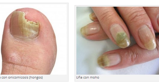 El cambio de la forma de las uñas en los pies el tratamiento