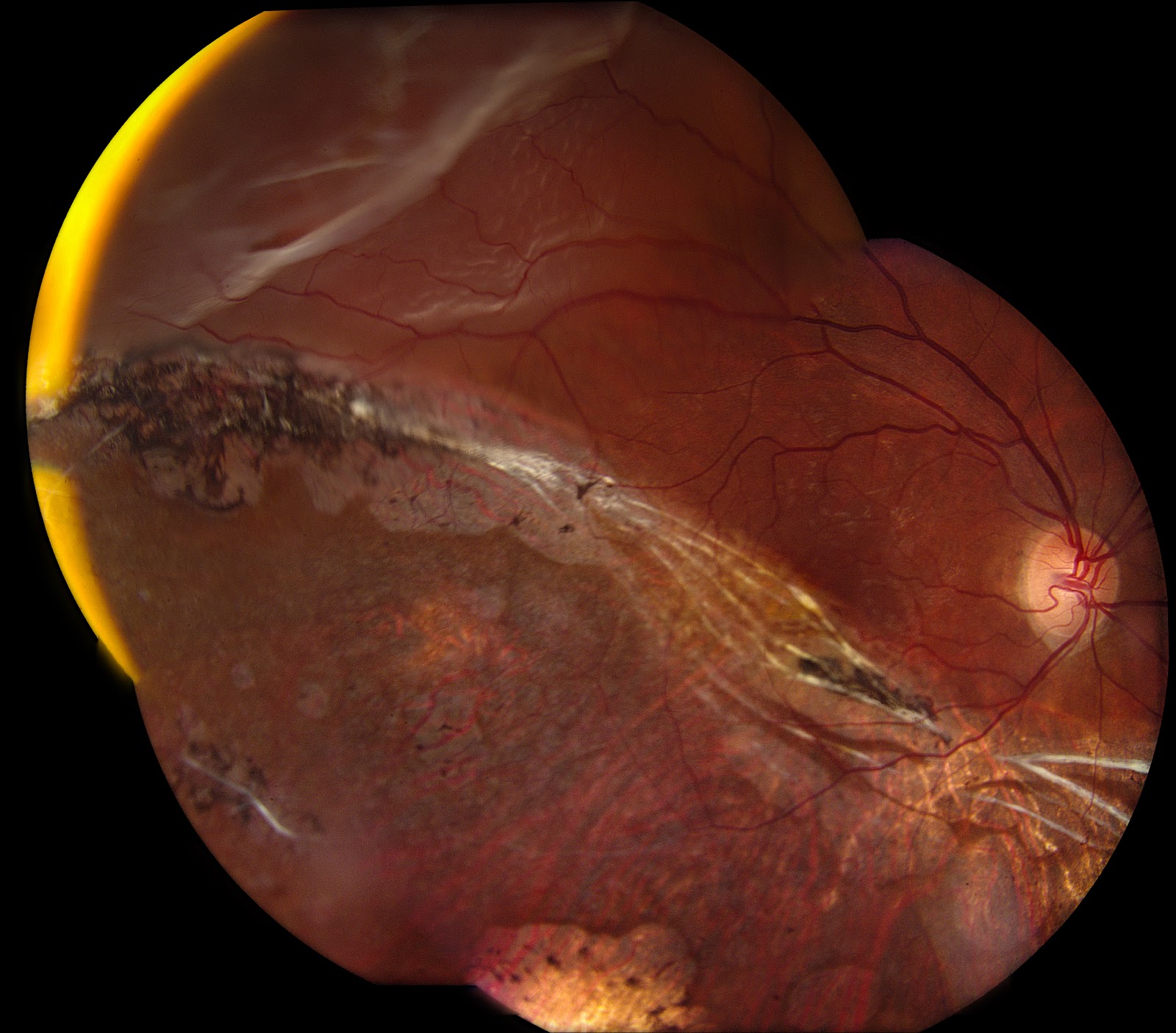 recovery from torn retina surgery recovery from torn retina surgery