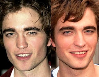 robert-pattinson-before-and-after-plastic-surgery-2(1).jpg