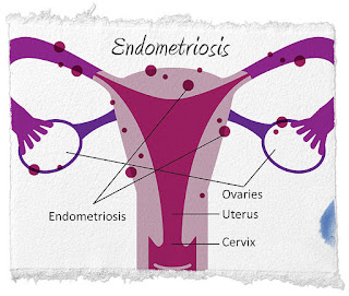 obat penyakit endometriosis yang efektif