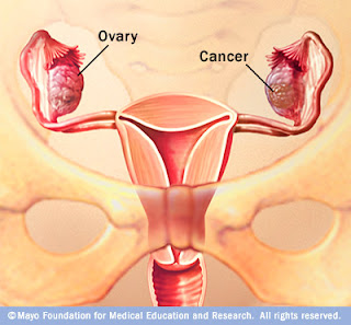 ما ينبغي أن تعرفه المرأة عن سرطان المبيض وسبل الوقاية  Ovarian+cancer