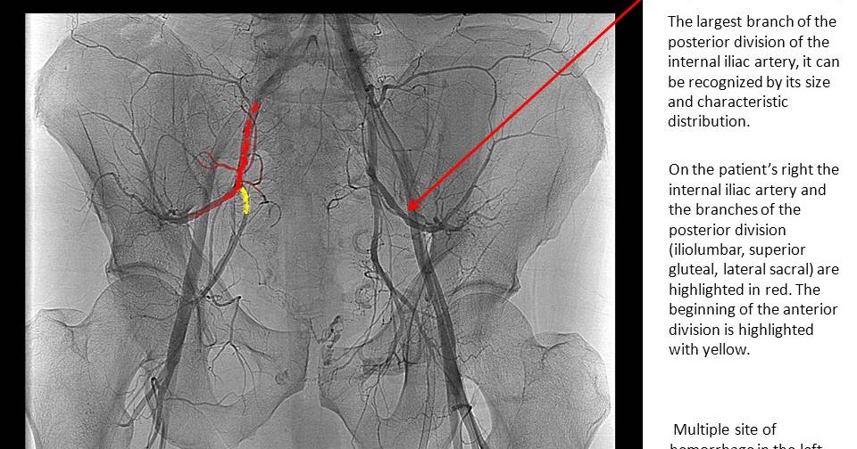 The Pump and the Tubes: Internal Iliac artery: Posterior Division
