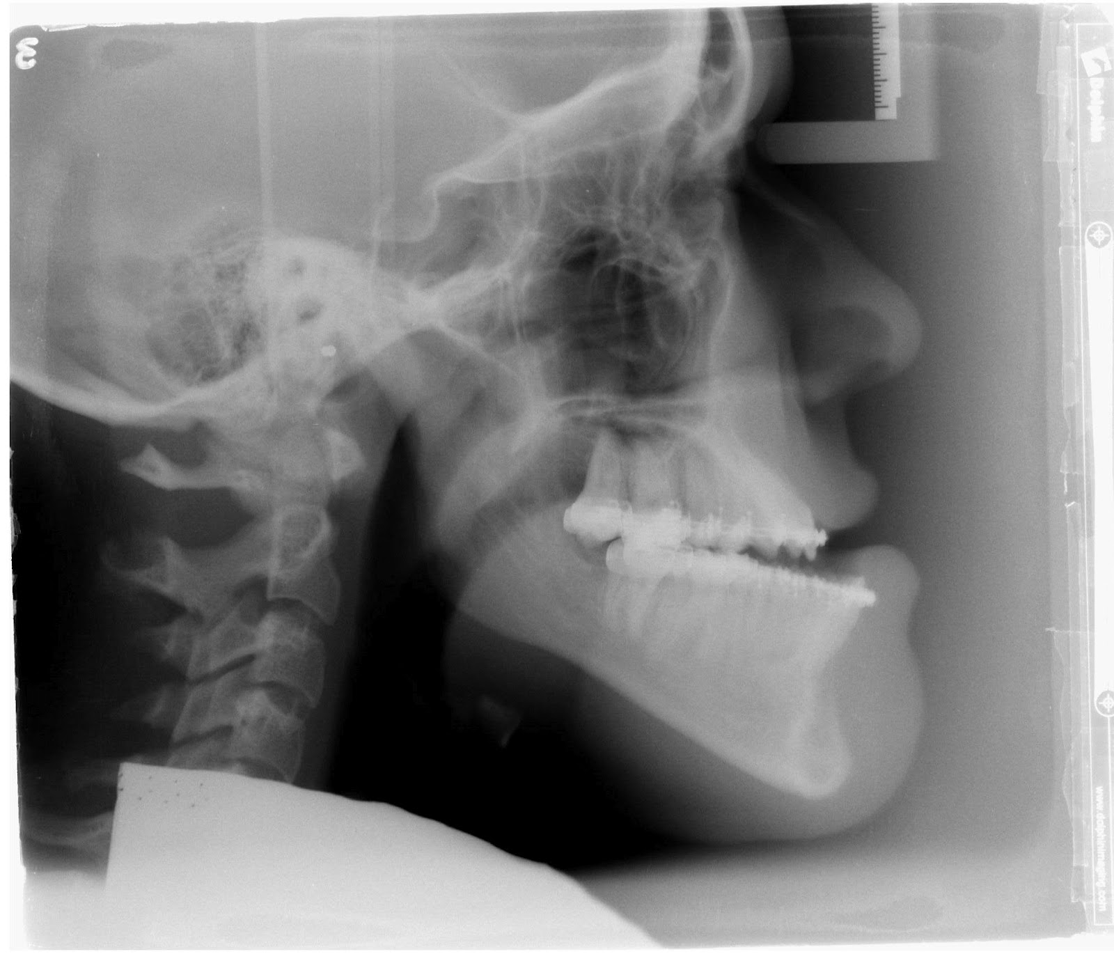 Kay's Double Jaw Surgery