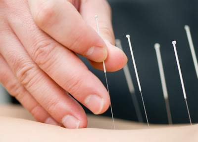 Image result for acupuncture