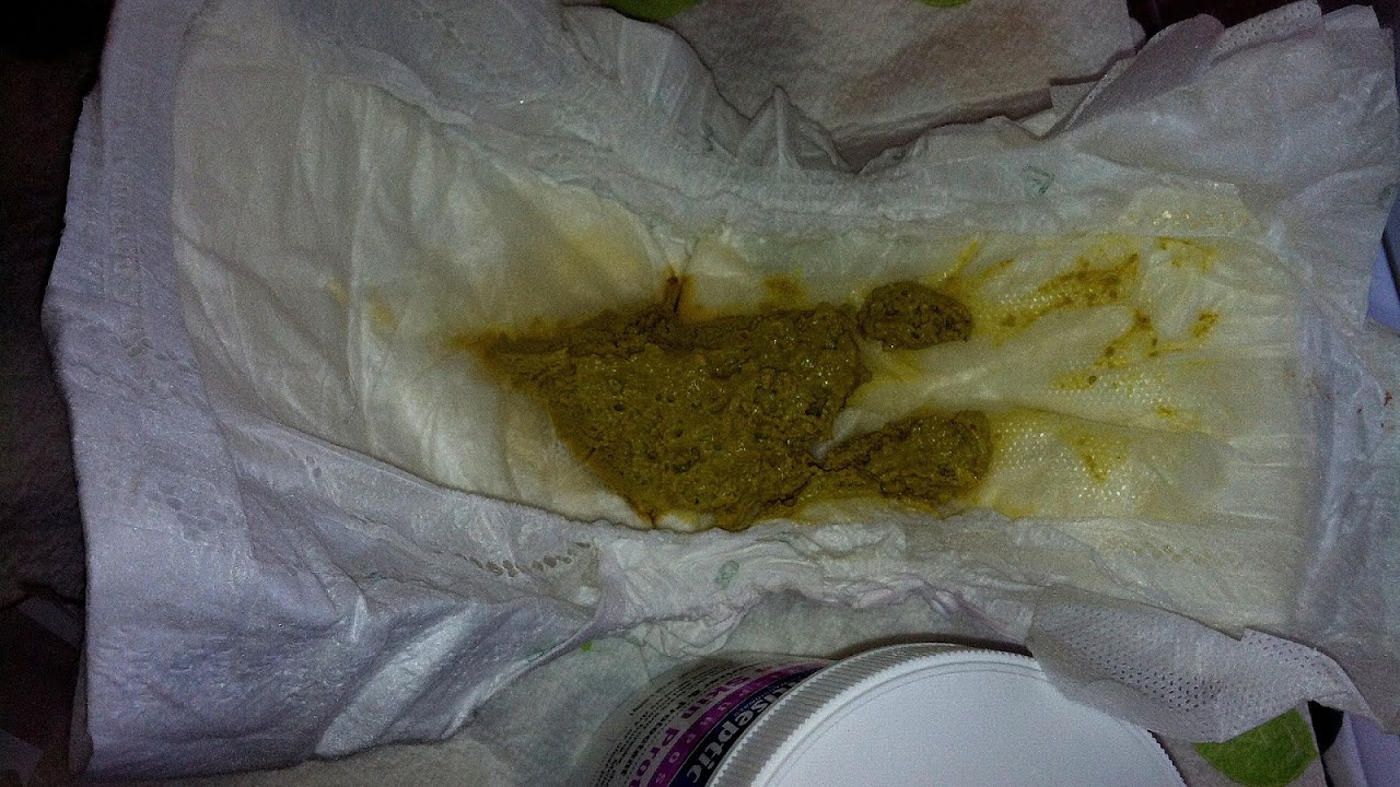 Steatorrhea Baby Poop Gray Grey Grey Choices