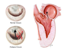 Child Growth Mitral Valve Prolapse