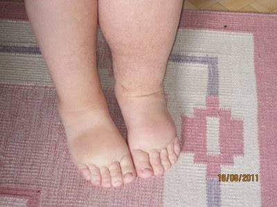 Linfedema MI Linfedema