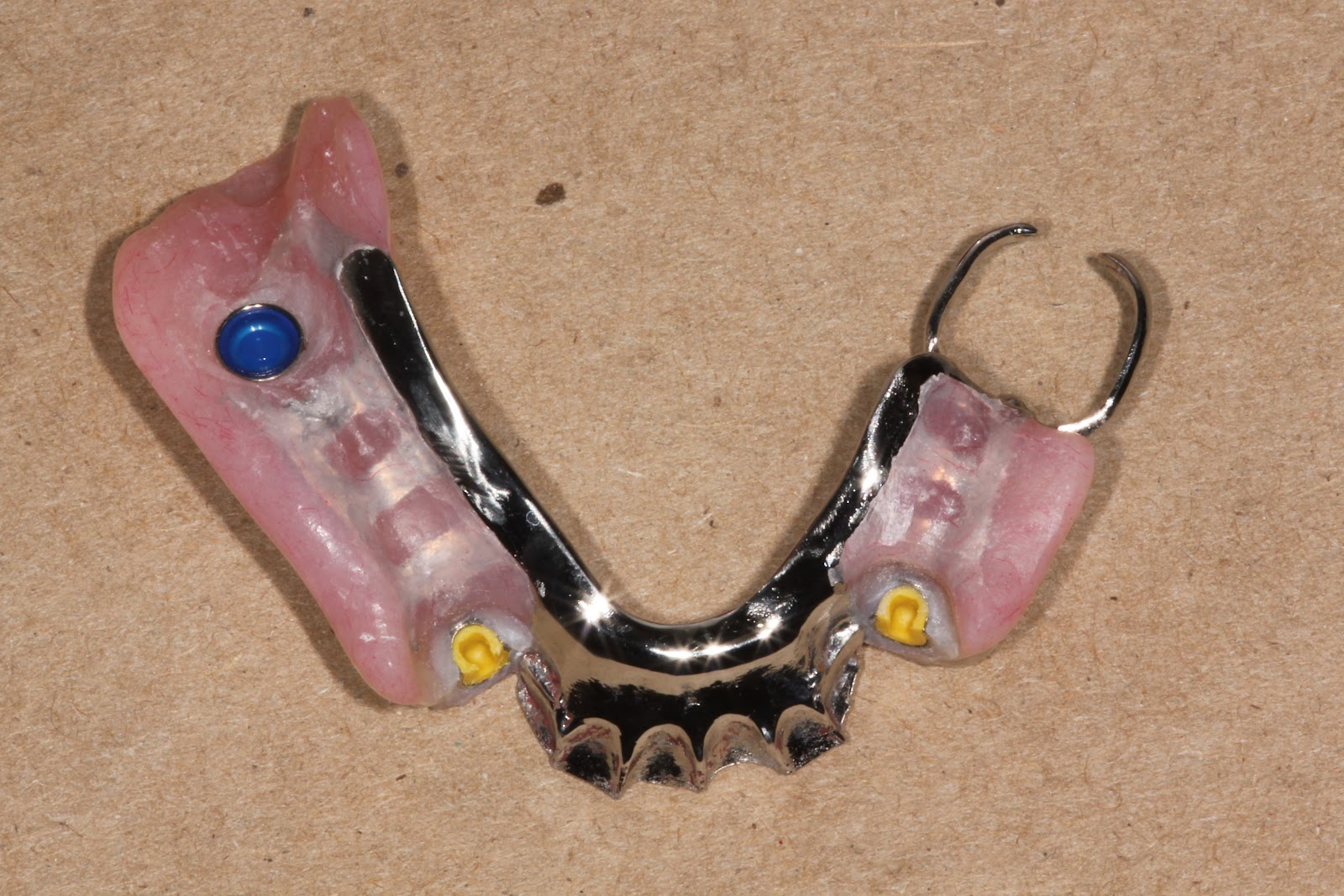 Boise Idaho Prosthodontics Maxillary Teeth and Mandibular Semi