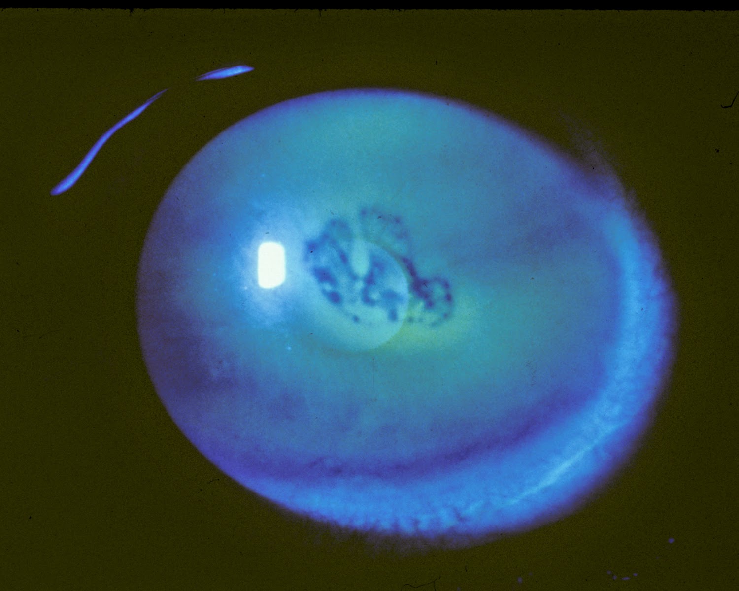 The Patient's Guide to Recurrent Corneal Erosion Eyedolatry