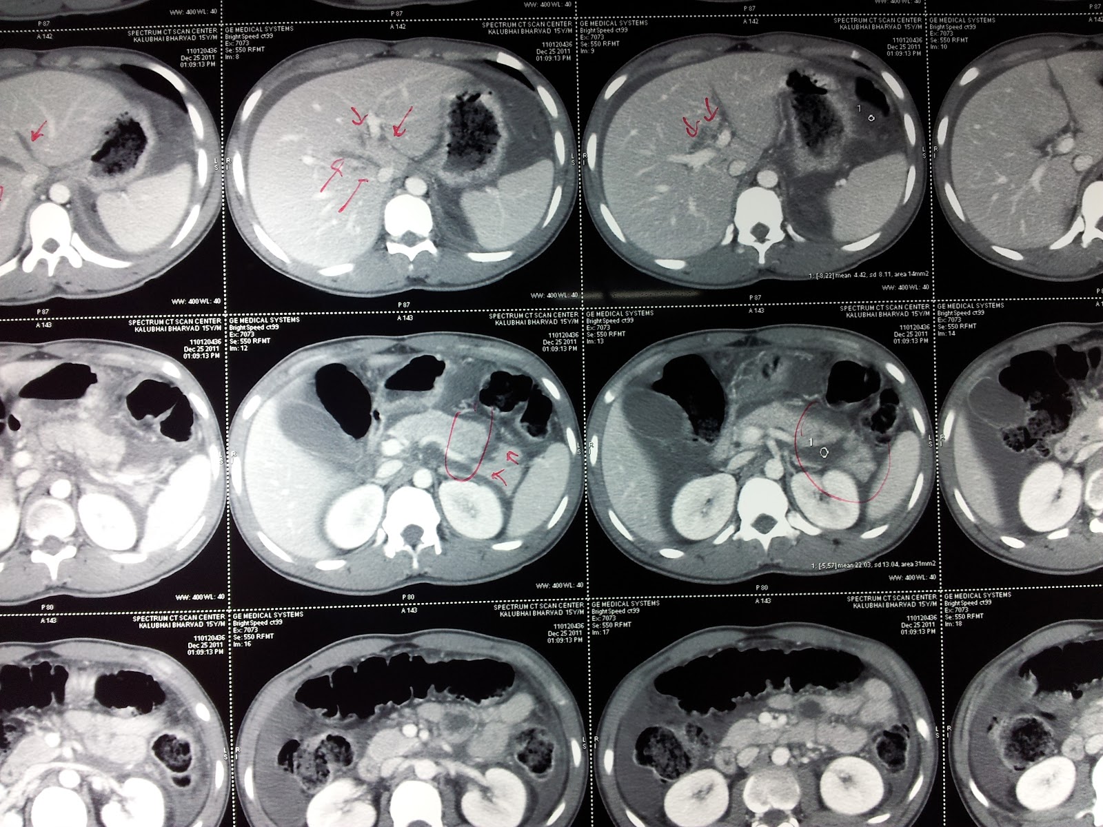 DR. KEYUR S. BHATT (MS, MRCSEd) CASE distal pancreatectomy with