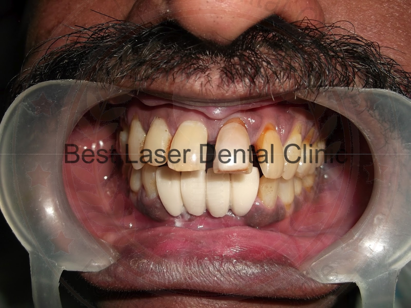 Brand new teeth by bicortical dental implants (How to strengthen the