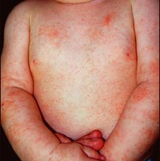 Diprosalik la loción de la psoriasis las revocaciones