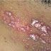 O que é HPV e Como Fazer o Diagnóstico?