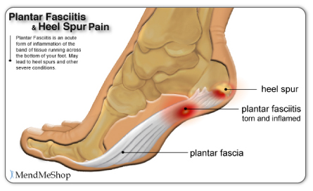 Painful Heel