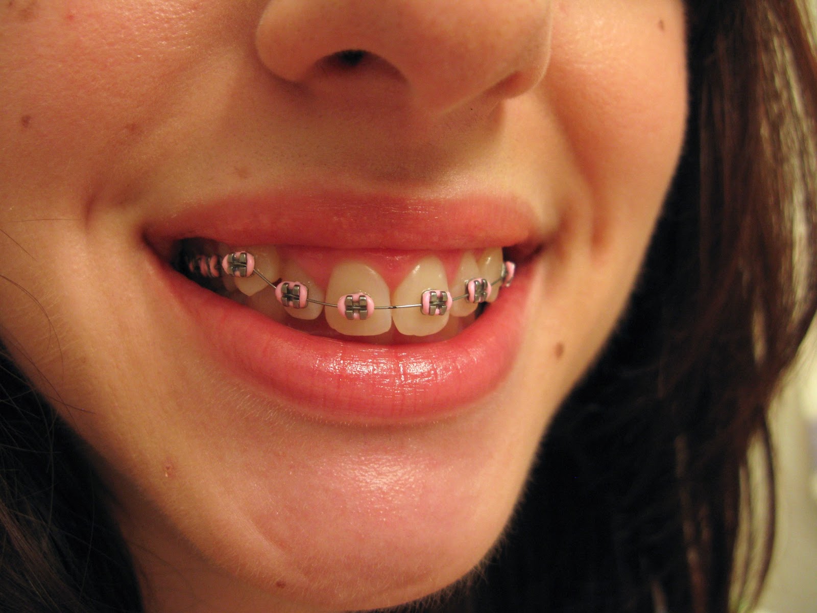 Braces at 22.