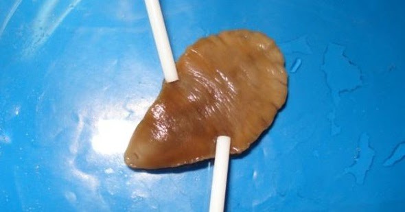 Liver Fluke Parasite Infection: Liver Fluke in Humans