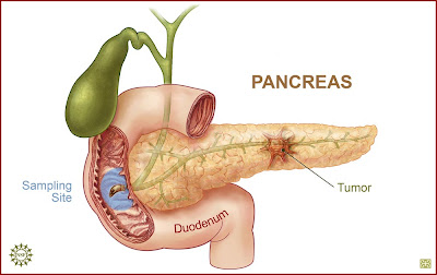 Fakta Tentang Kanker Pankreas