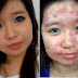 Impressionante! Blogueira cobre acne severa do rosto usando apenas maquiagem!