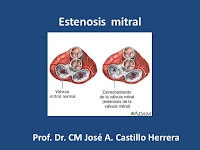 Estenosis Mitral