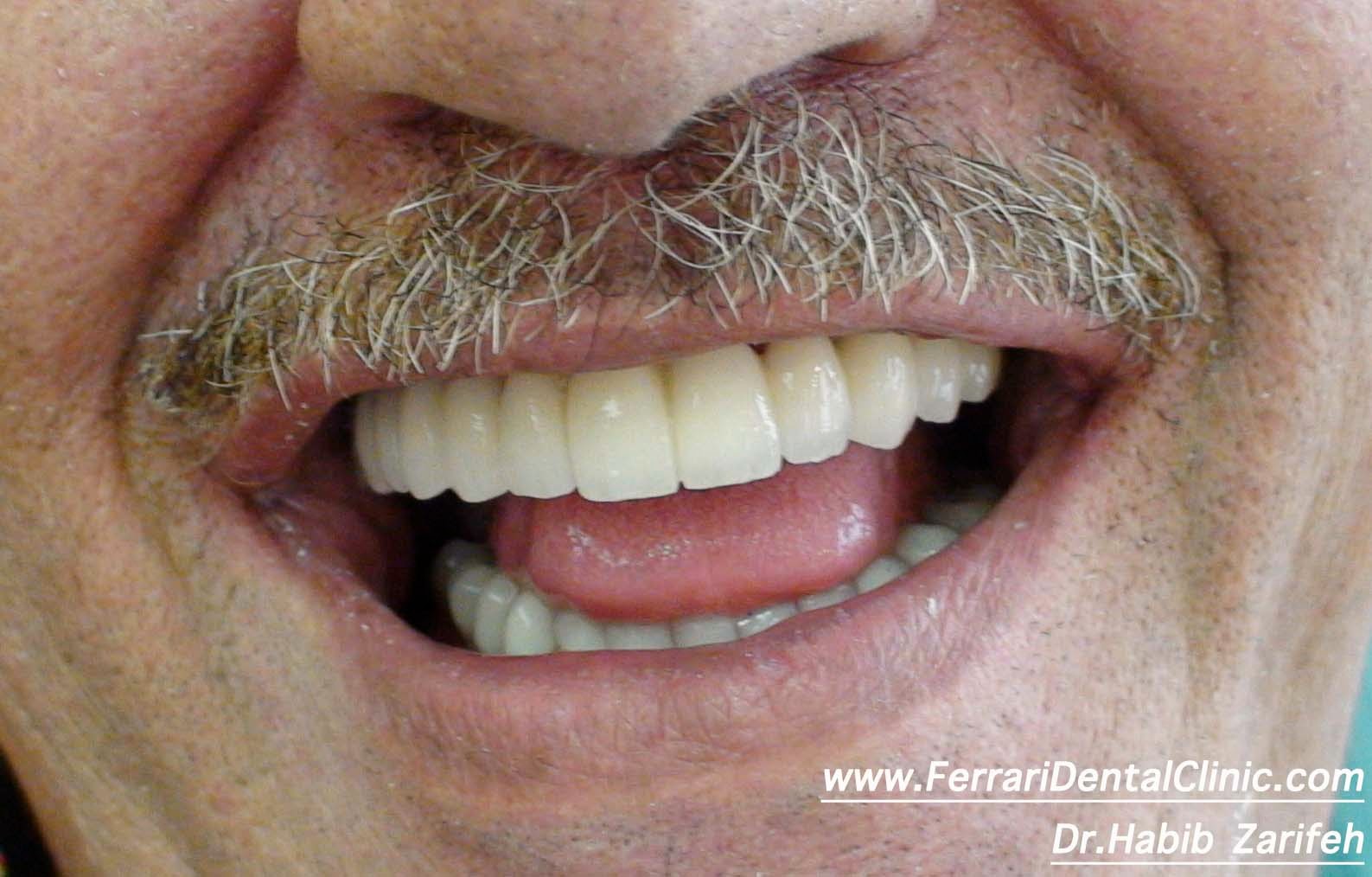The dental implants specialist in beirut Dr.Habib Zarifeh