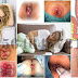 Berobat Wasir (Hemoroid) Selain Ke klinik Bafar thumbnail