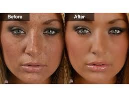 Melasma တင္းတိပ္ - သစ္ထူးလြင္ (က်န္းမာေရး) Melasma တင္းတိပ္ - သစ္ထူးလြင္ (က်န္းမာေရး)