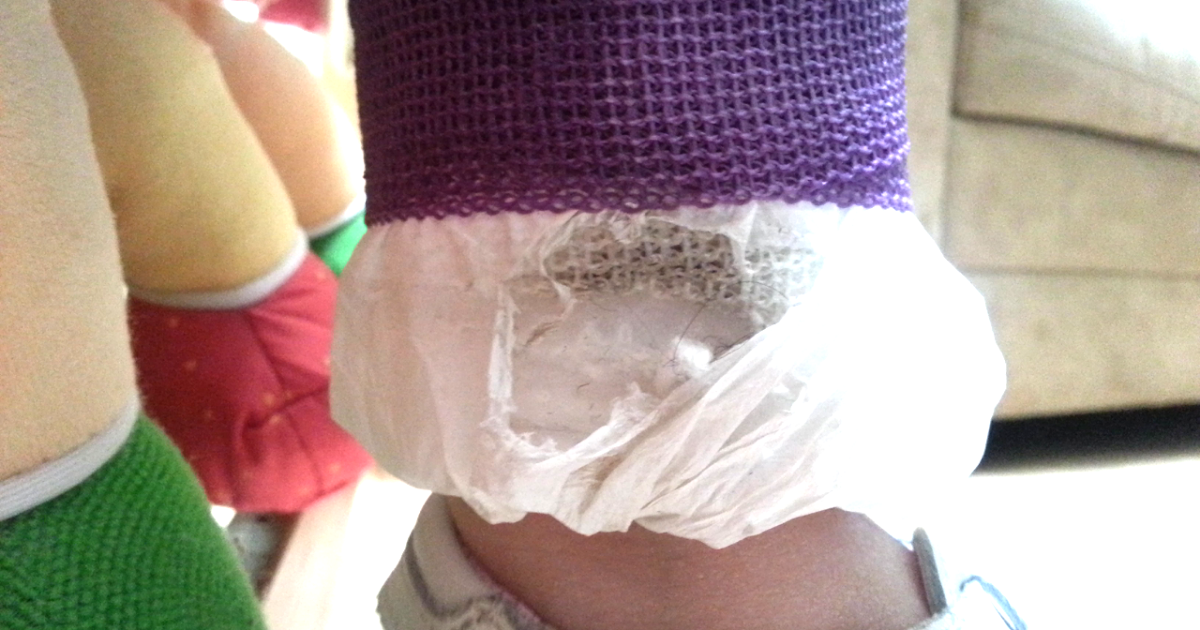 "Hip" Chick New Spica Cast/Adjustments