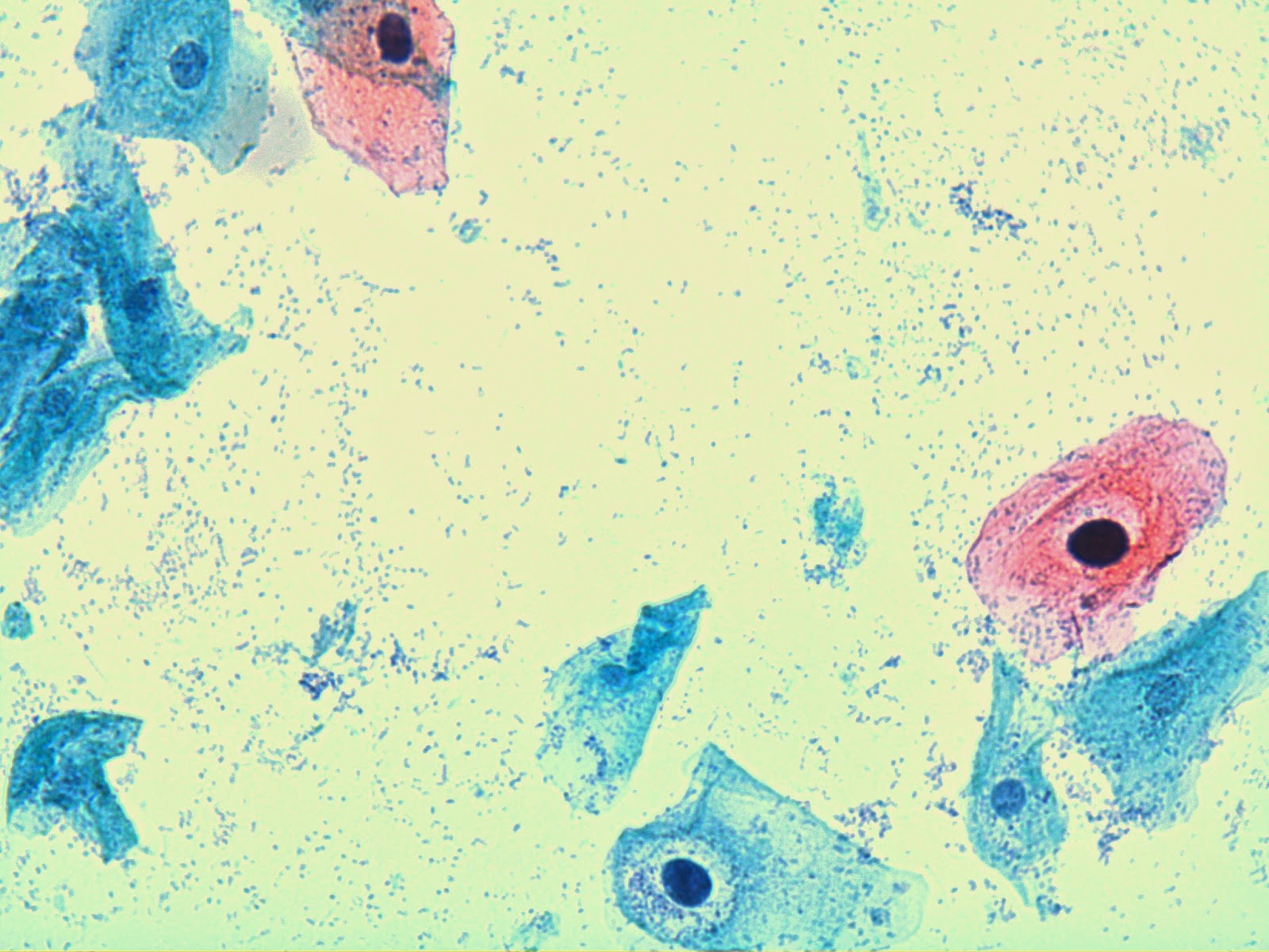 endometrial most cancers what's it existence after cervical cancer treatment