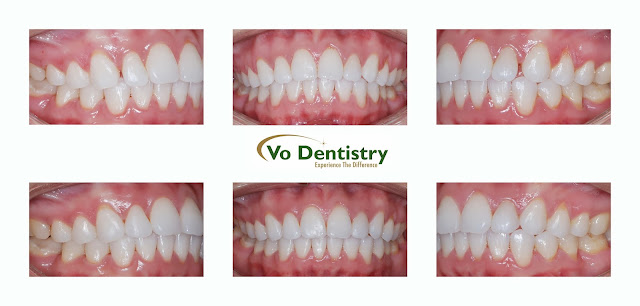 Peg laterals, small teeth, tooth colored restorations, composite restorations, Lawrenceville, Norcross, Lilburn, Dacula, GA, Georgia