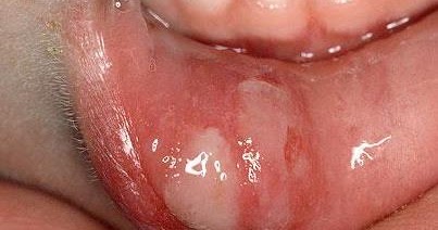 Mouth full of ulcers - Hot Clip Porn Images & Video Milfs bang boats